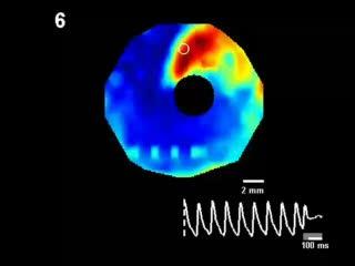 Easing the Heart Back to Normal Rhythm (6 of 8)