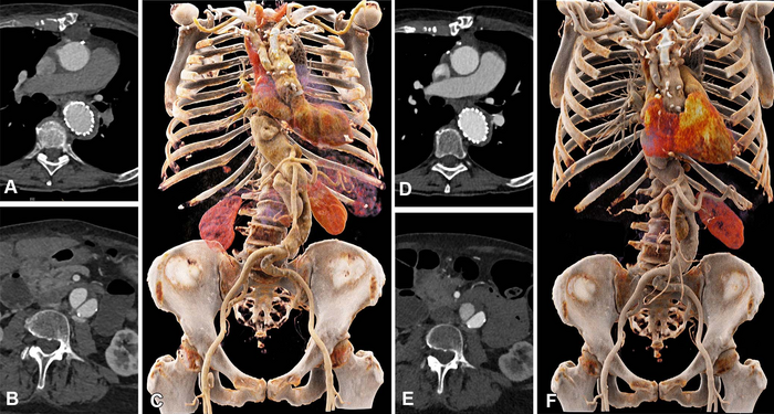 Photon-Counting CT Enables Lower Contrast Media for Aortic Imaging