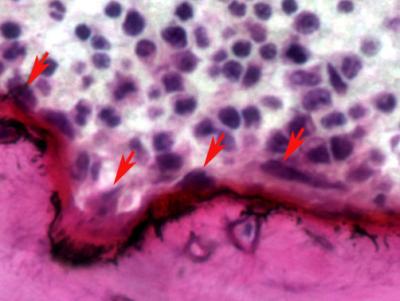 Hajdu-Cheney Mouse Femur
