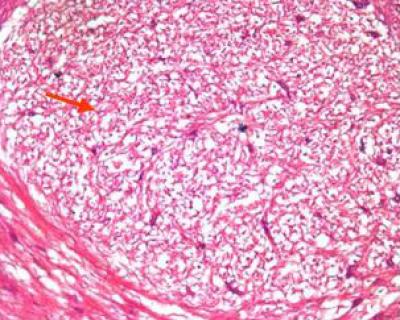 Nucleus Tractus Solitarii Damage