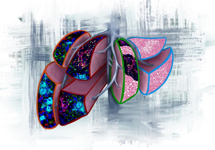 Image illustrating four prognostic scenarios that may be found in liver biopsies when pancreatic cancer is diagnosed before metastasis.