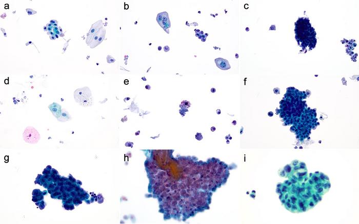 Negative for high-grade urothelial carcinoma (NHGUC)