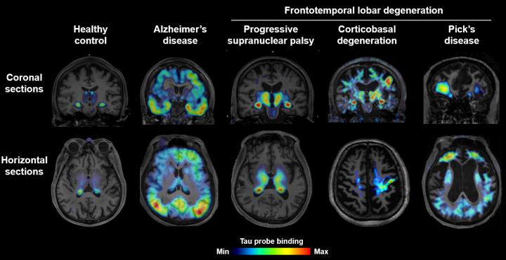 PET Imaging of AD - Coronal and Horizontal