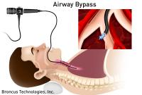 Airway Bypass Procedure
