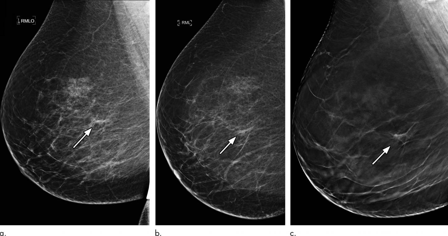 3D Mammography Significantly Reduces Breast Biopsy Rates