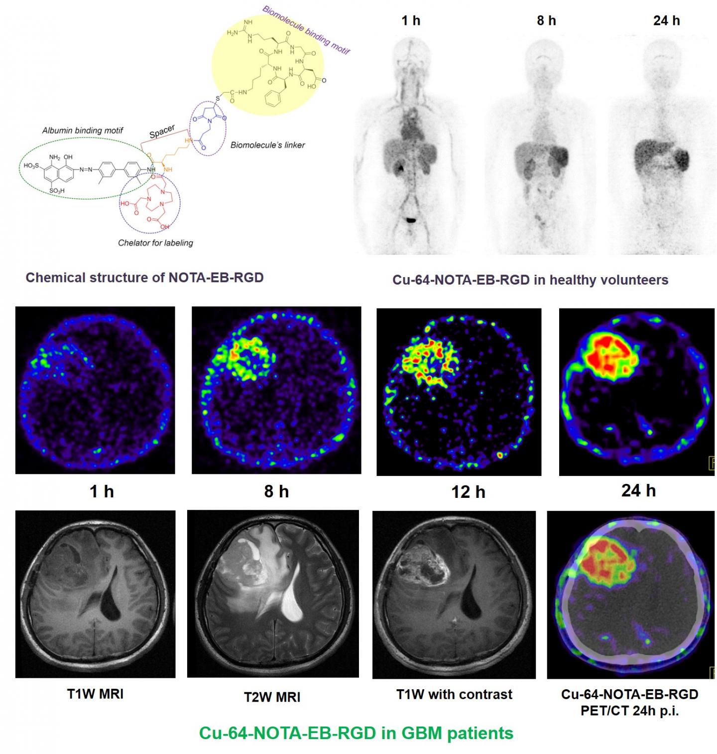 PET images of glioblastoma patient