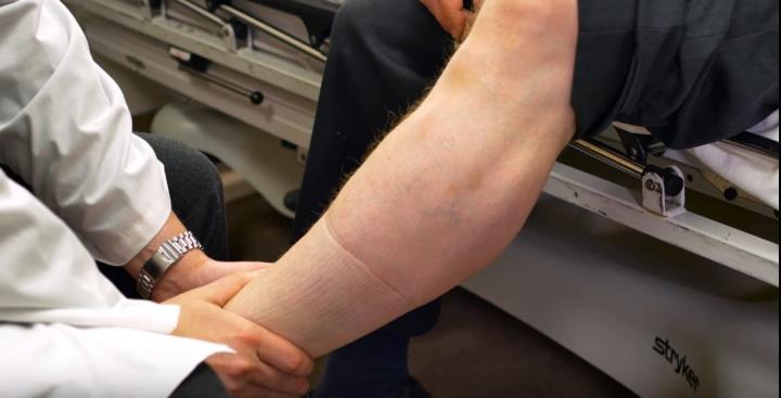 Venous Thromboembolism Leg Exam