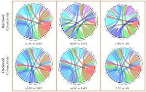 Visualization of altered connections at different stages of Alzheimer's disease