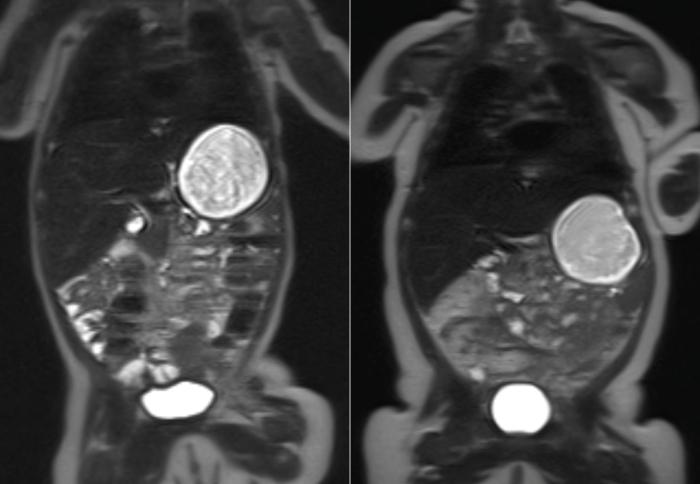 MRI Scans of Two Infants