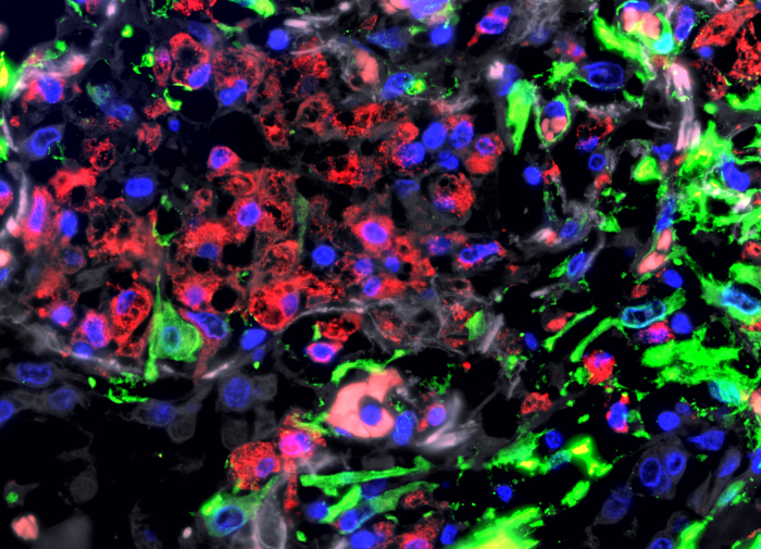 Macrophages in the lungs of a patient with severe COVID-19