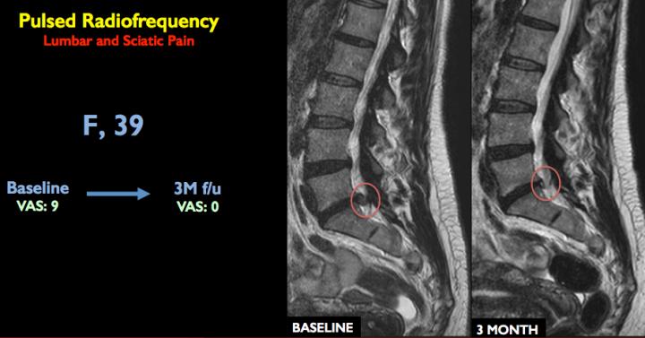 Minimally Invasive Treatment Provides Relief from Back Pain (1 of 2)