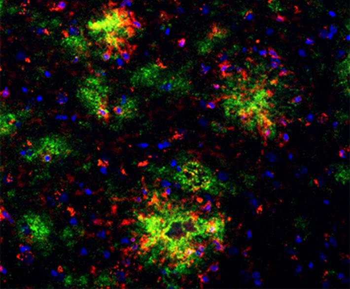 Amyloid Beta Plaques
