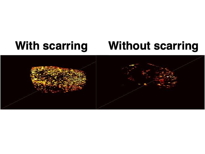 Degree of Scarring Within the Kidney