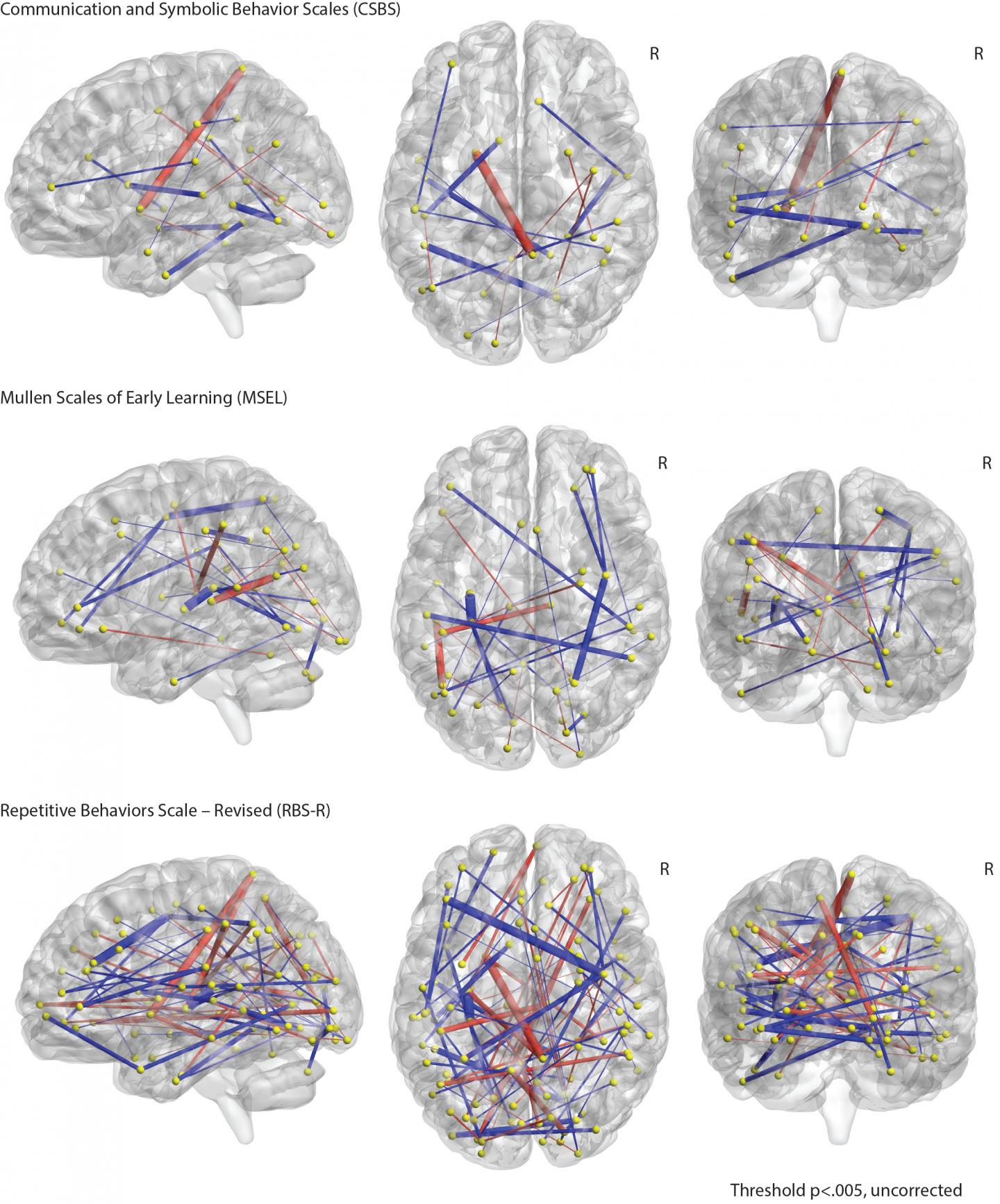 Detecting Autism in Infants Before Symptoms Emerge