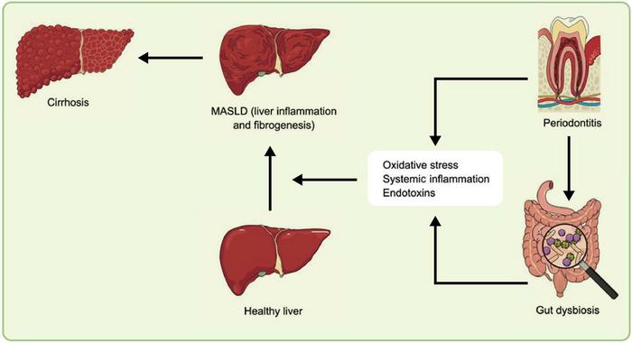 Periodontitis increases oxidative stress and causes dysbiosis in the gut axis liberating endotoxins