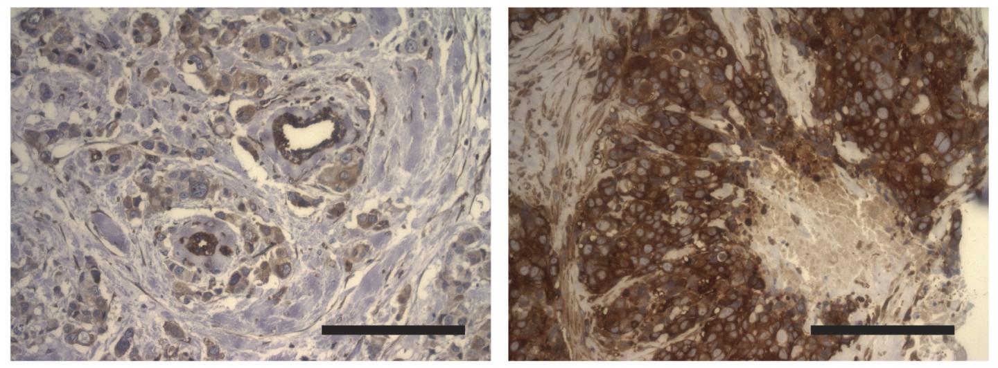 : NF-&kappa;B is elevated in breast tumors after therapy