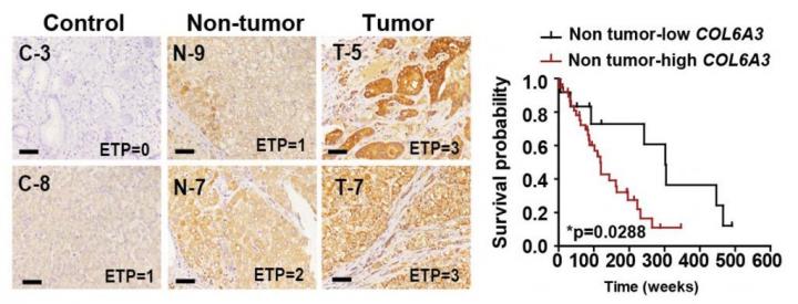 ETP Expression and Survival Rate in HCC Tissues