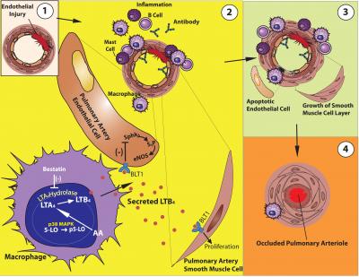 LTB4 Molecule Linked to High Blood Pressure in Heart & Lungs (1 of 3)