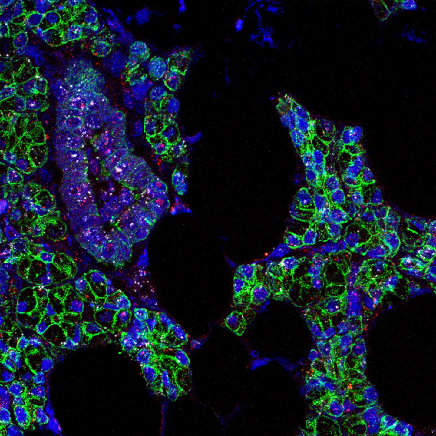 SARS-CoV-2 Found in Salivary Glands