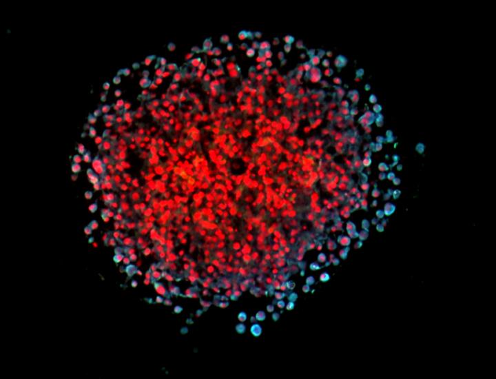3-D Spheroid of Cultivated Breast Cancer Cells