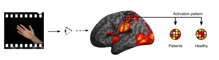 Patients Suffering from CRPS