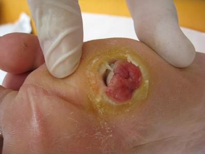 A Diabetic Foot Ulcer