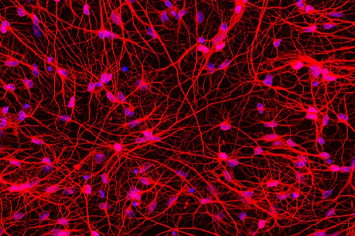 Altering Huntington's Patients' Skin Cells Into Brain Cells Sheds Light On Disease
