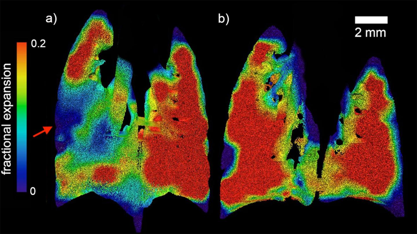 Regional Fractional Expansion of Lungs
