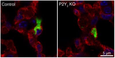 Tumor Cell Penetrates the Endothelial Barrier