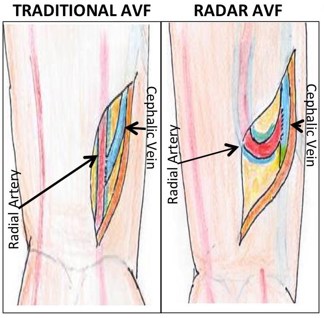 A Reverse Approach to Vessel Surgery May Boost Clinical Outcomes in Dialysis (1 of 4)