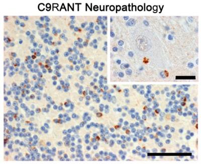 C9RANT Neuropathology in c9FTD/ALS