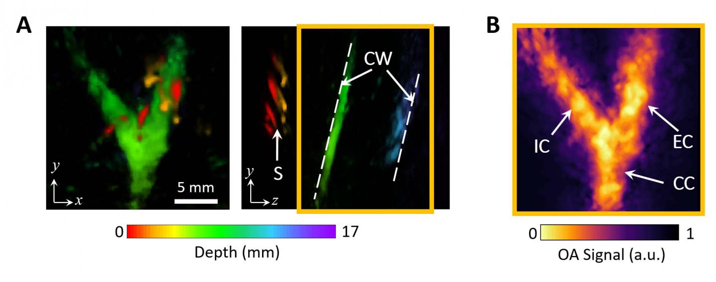 Novel Technique Accurately Assesses Cardiovascular Risks