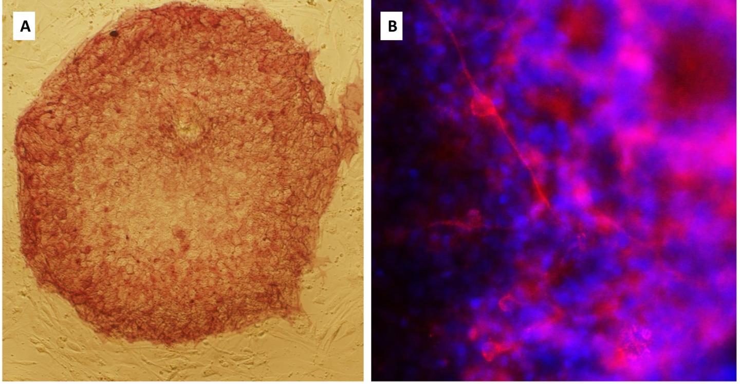 Derivation of Induced Pluripotent Stem Cells With NBS and Their Differentiation into Early Neurons