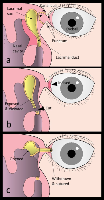 Schematic diagram of the surgical procedure