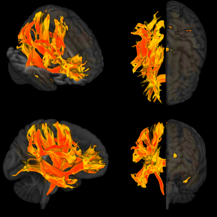 Specific regions of the brain that are damaged by high blood pressure and are involved in a decline in mental processes and dementia
