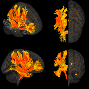 Specific regions of the brain that are damaged by high blood pressure and are involved in a decline in mental processes and dementia