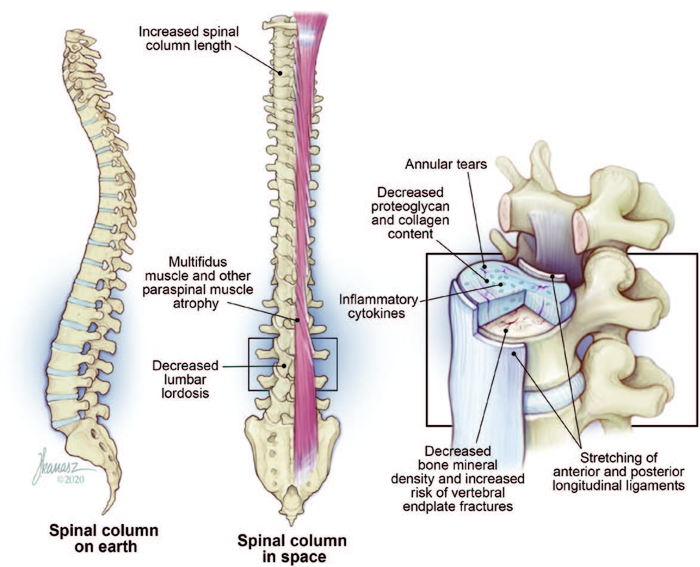 Back pain common among astronauts offers trea