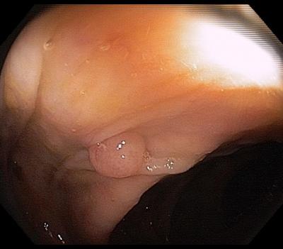 Polyp Found on Repeat Colonoscopy