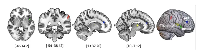 Brain regions predicting symptomatic improvement of body dysmorphic disorder (BDD) by psilocybin