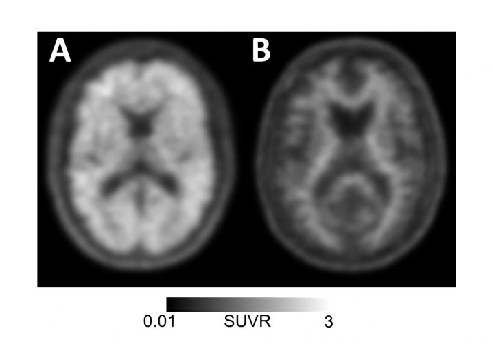 Image of Amyloid PET Scan