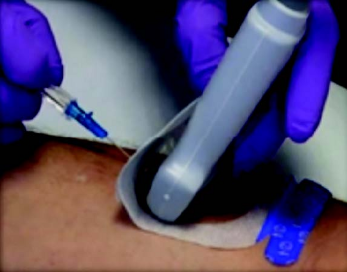 UltraDrape Minimizes UGPIV Risks - Image 3