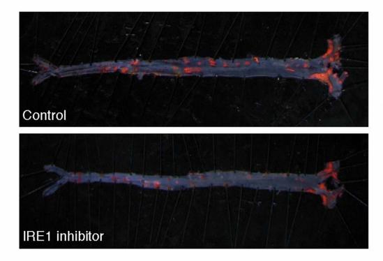 Atherosclerotic Lesions