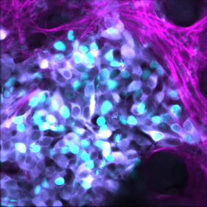 1. Neuroblastoma chemoresistance Credit Max Nobis / Garvan