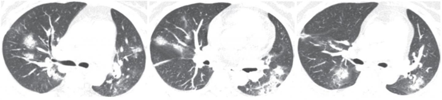 58-Year-Old Woman with Adenovirus Infection