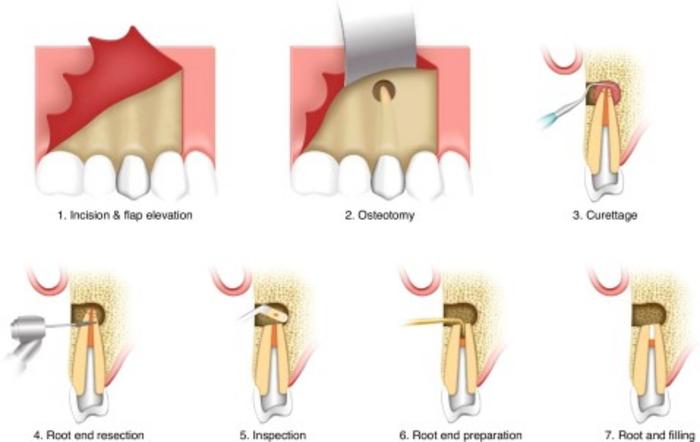 Schematic diagram of clinical operating procedures for apical microsurgery