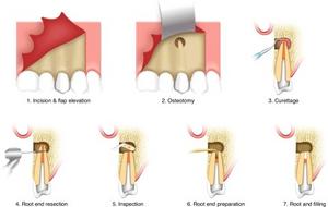 Schematic diagram of clinical operating procedures for apical microsurgery