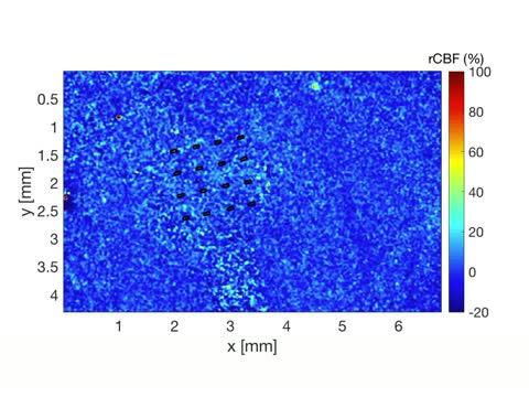 Cerebral Blood Flow after Cortical Spreading Depression Observed though Graphene