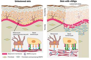 Disappearance of pigment-producing cells in vitiligo