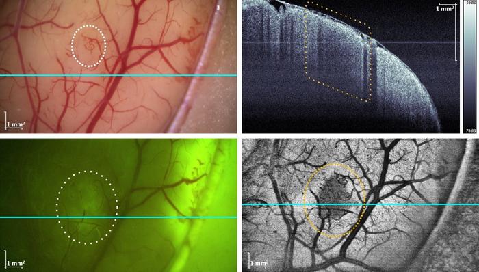 Brain surface scan with tumor