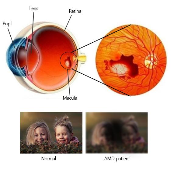 Position of the Macula and Effects of AMD